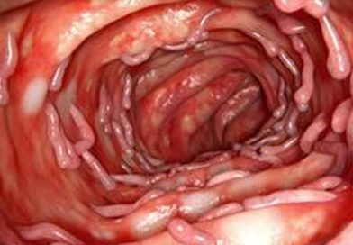 Compusul care poate inhiba activitatea genei responsabilă de boala inflamatorie intestinală