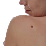 Compusul care poate trata cea mai gravă formă de cancer de piele!