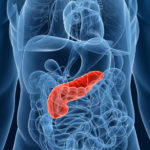O nouă metodă de diagnosticare a cancerului pancreatic