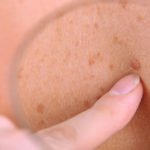 Cercetătorii au creat sonda care descoperă cancerul de piele într-un timp foarte scurt