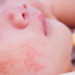 Legătura dintre microbiota intestinală și alergiile la nou-născuți
